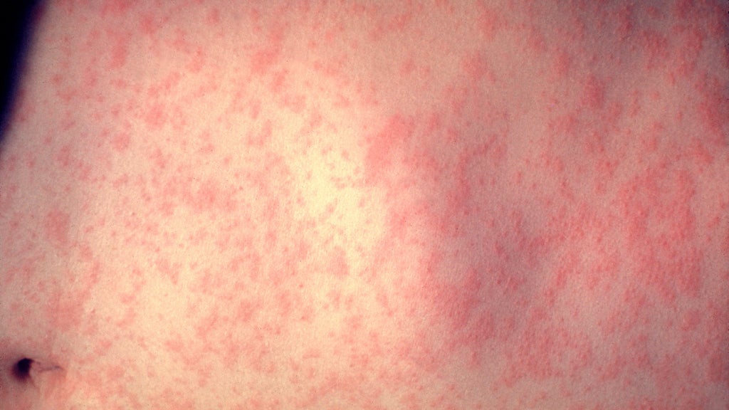 25 cases of measles identified in central, southeastern Minnesota, MDH says — WCCO / CBS Minnesota, Rosemount Health news